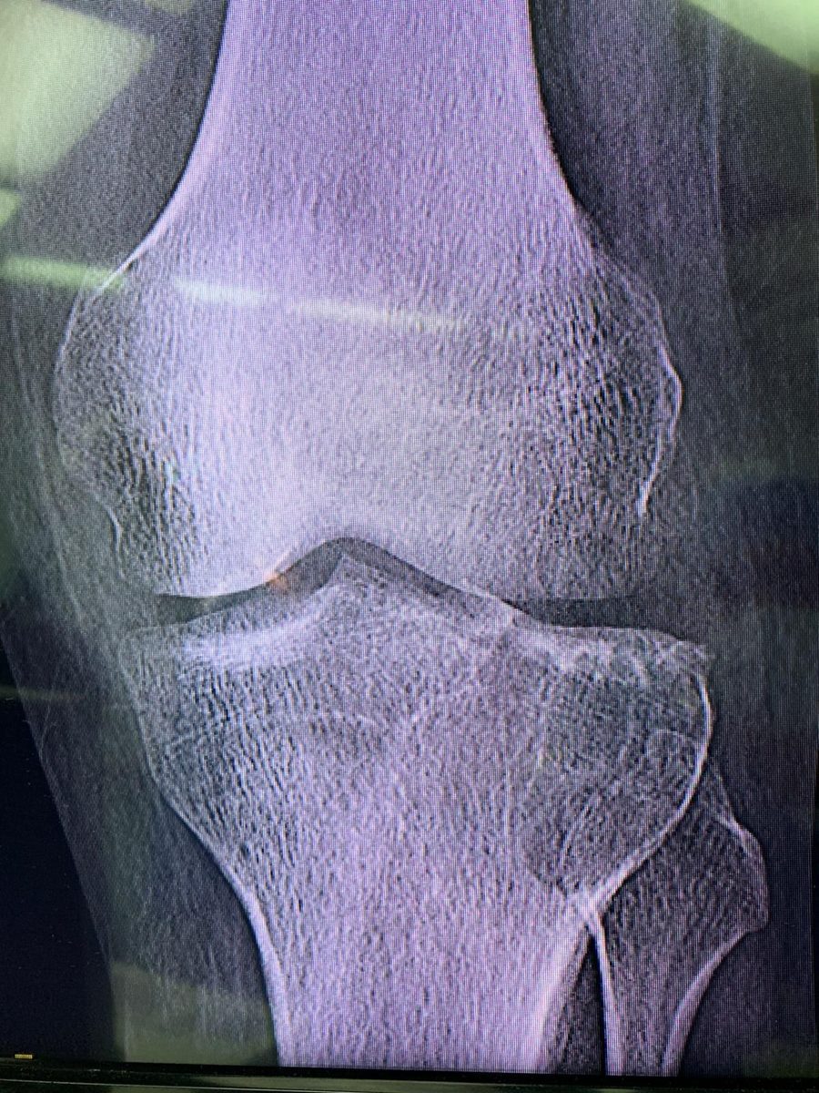 X-ray of the knee at presentation