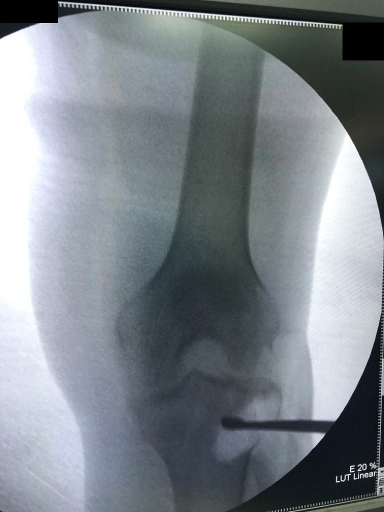 Curettage under X-ray guidance