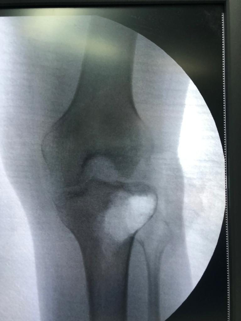 X-ray after complete curettage