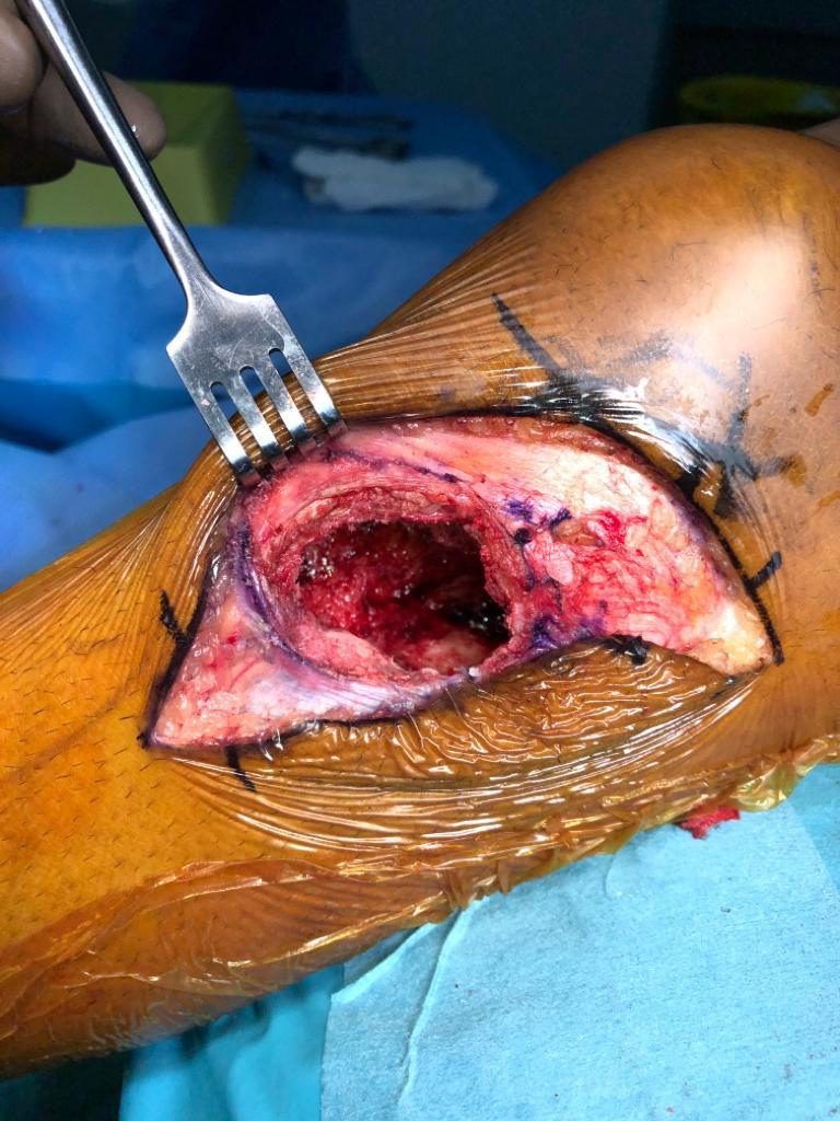 The cavity after curettage during surgery