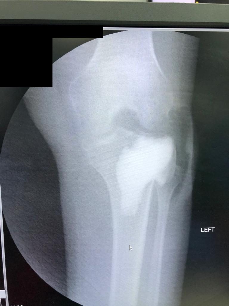 X-ray after cementation