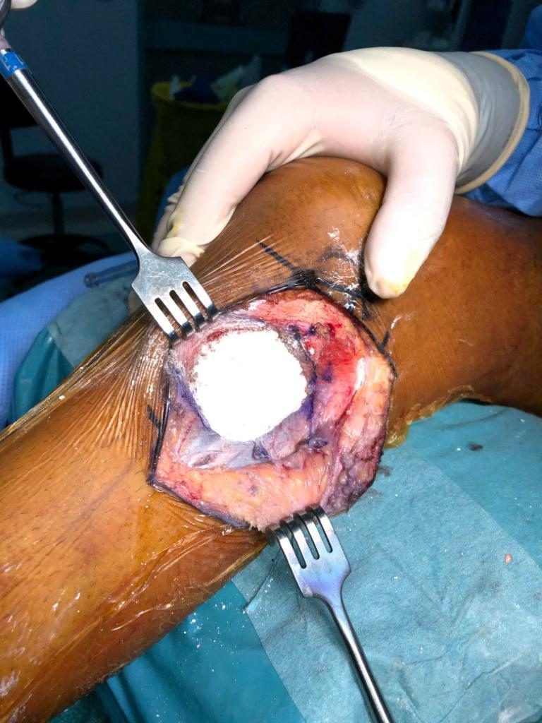 Bone cement in the cavity during surgery