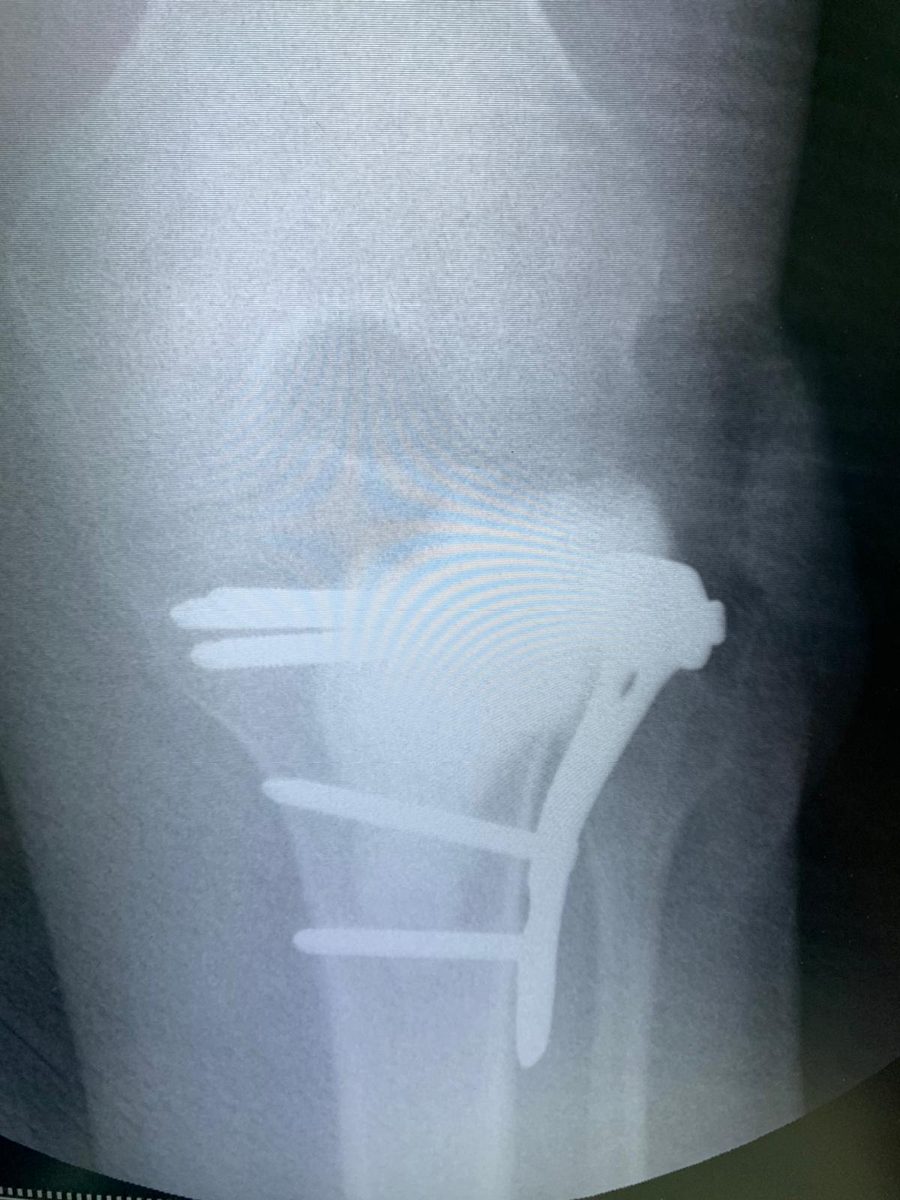 X-ray after plate fixation