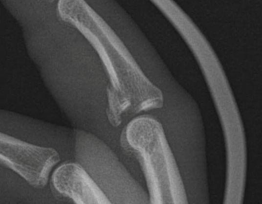 X-ray of the finger before surgery