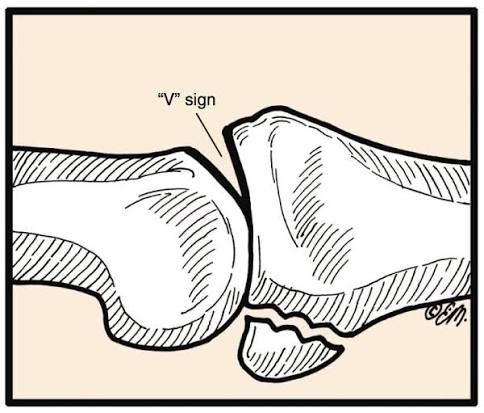 Illustration of the V sign
