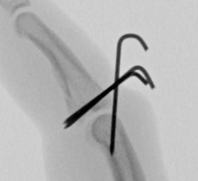 X-ray during surgery showing the wires