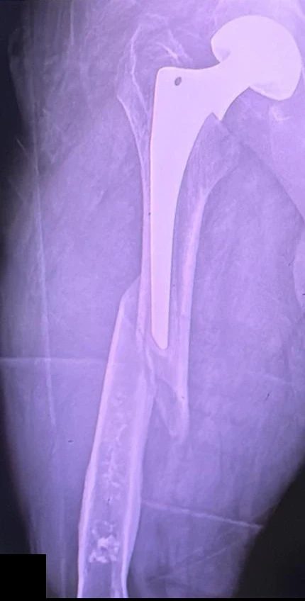 X-ray at presentation showing the hip replacement and the fractured femur