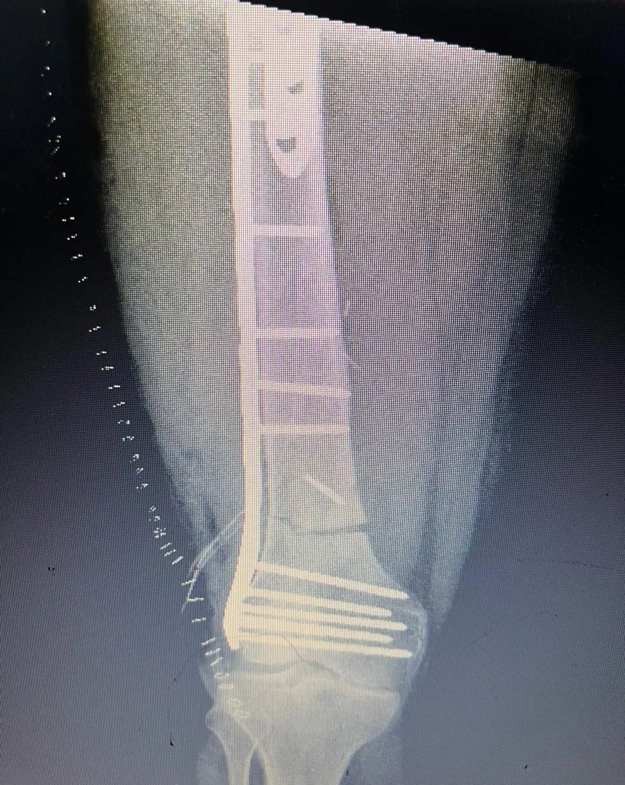 X-ray after reconstruction, near the knee