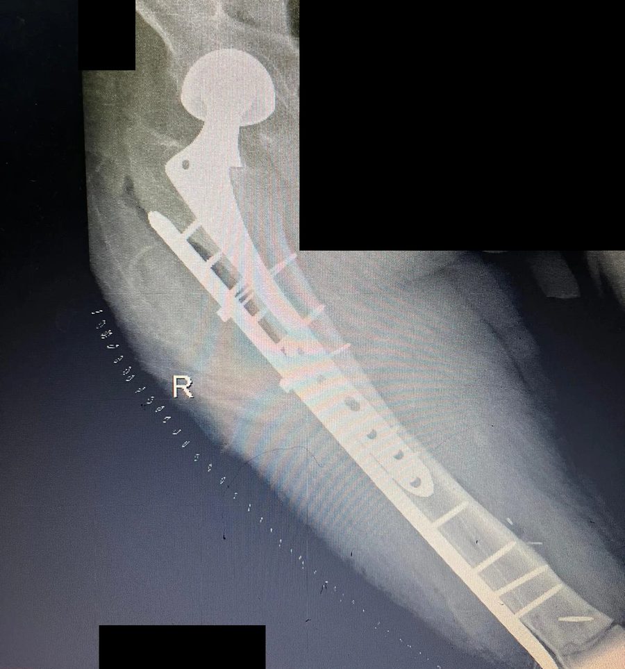 X-ray after reconstruction, upper femur with the hip replacement